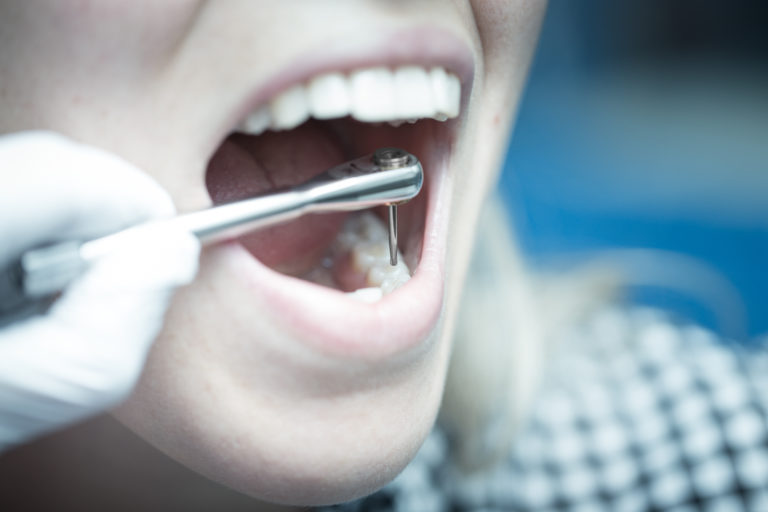 Avec la clé dynamométrique Omega, le dentiste peut se concentrer sur le travail dans la bouche et n’a pas besoin de se soucier de la position de ses doigts ou de la lecture de la valeur sur la clé. Avec la clé dynamométrique Omega, le dentiste peut se concentrer sur le travail dans la bouche et n’a pas besoin de se soucier de la position de ses doigts ou de la lecture de la valeur sur la clé.